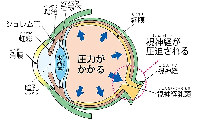 眼科疾患（急性緑内障発作）