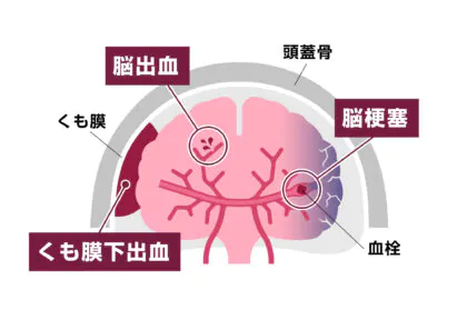 血管性認知症